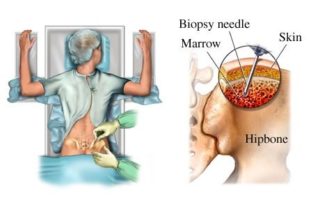 Bone Marrow Concentrate Collection- Risks and Expectations